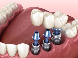 diş implant tedavisi nedir