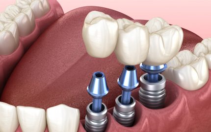 diş implant tedavisi nedir