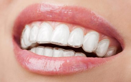 Invisalign Tedavisi Nedir?