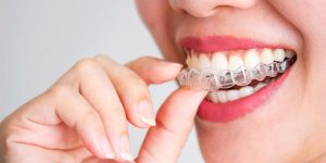 Invisalign Ve Diğer Ortodontik Tedaviler Arasındaki Farklar Nelerdir?