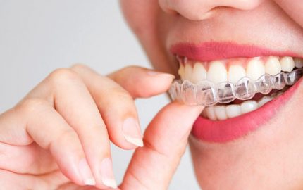 Invisalign Ve Diğer Ortodontik Tedaviler Arasındaki Farklar Nelerdir?