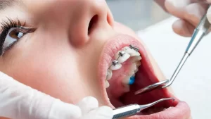 Ortodontik Tedavi Nedir?